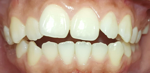 Antes del tratamiento