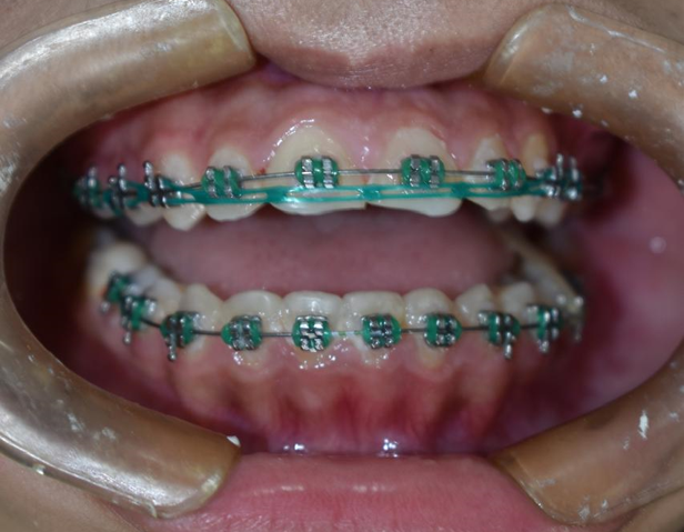 Antes del tratamiento