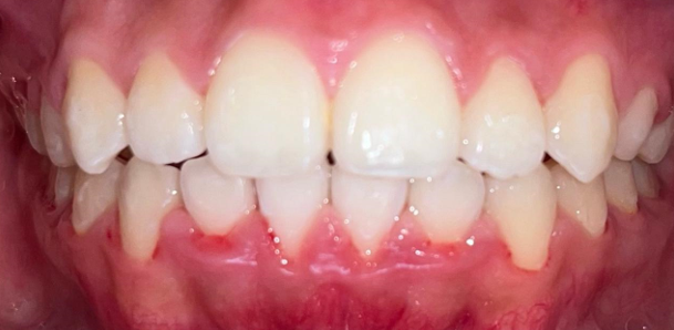 Después del tratamiento