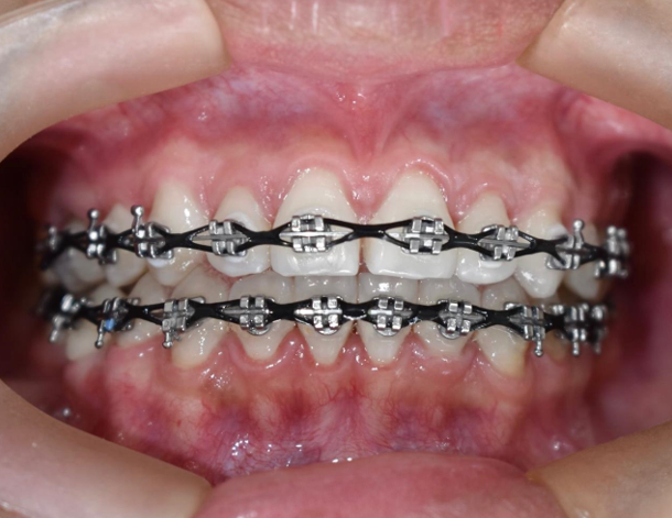 Después del tratamiento