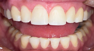 Después del tratamiento