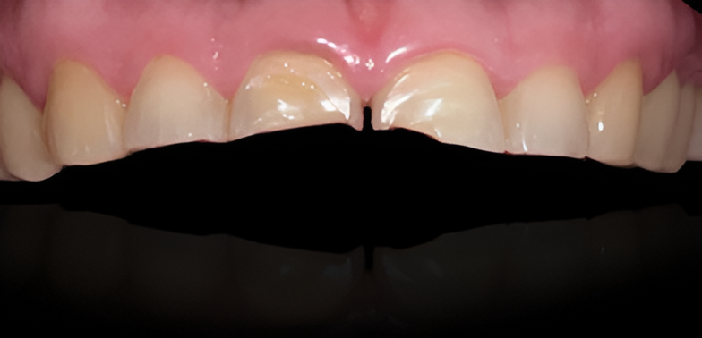 Antes del tratamiento